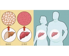 脂肪肝蚂蚁庄园 吃素的人得脂肪肝是什么原因